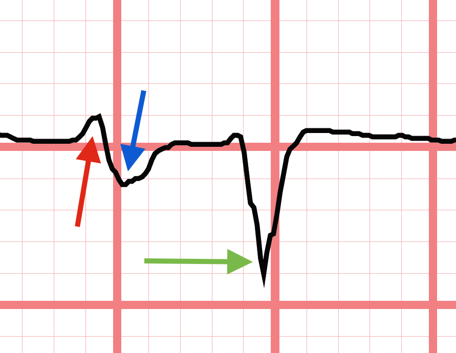 Monophasic Vs Biphasic Waveform